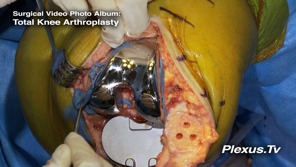 Total Knee Arthroplasty - Plexus Surgical Video Photo Album