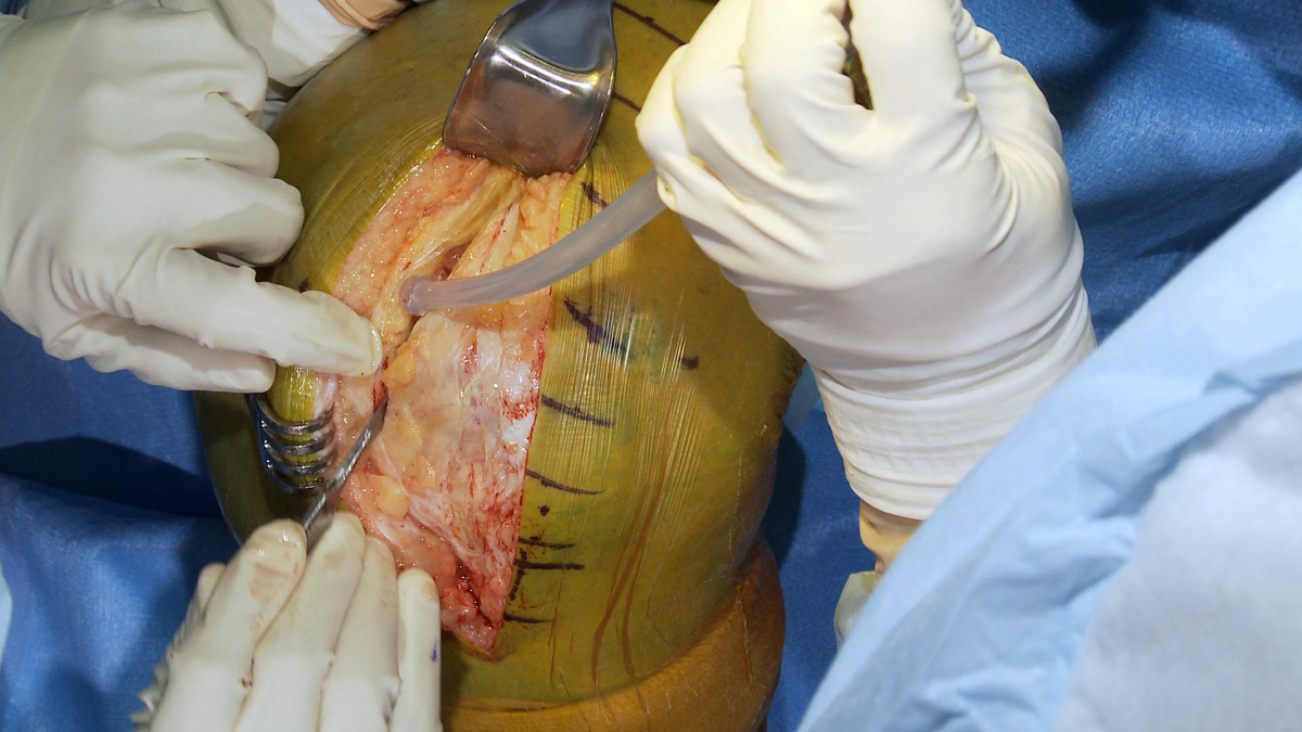 Total Knee Arthroplasty Paramedian Incision