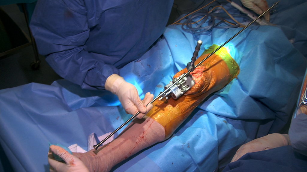 Alignment Rod During Total Knee Arthroplasty