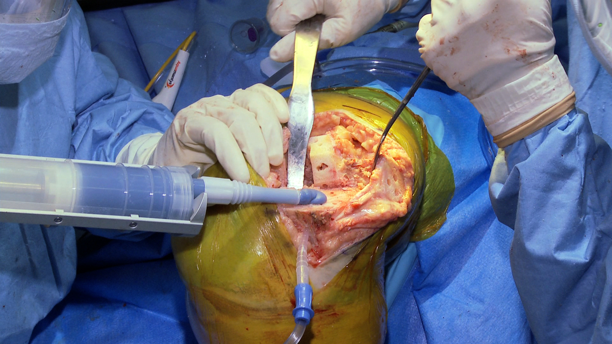 Lower Camera Angle in Total Knee Replacement